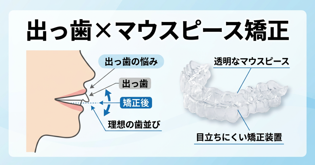 どこからが「出っ歯」？　マウスピース矯正での治し方や抜歯について